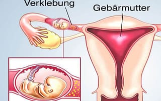 Nach Eileiterschwangerschaft IVF oder ICSI