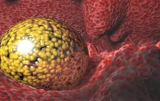 Können Embryonen nach Transfer rausfallen Embryo in Gebärmutter
